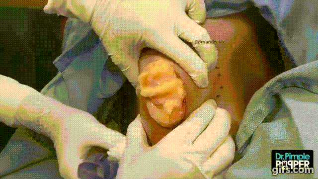 Excision d'un gros lipome sur l'épaule à l'aide de la technique tumescente gif animé